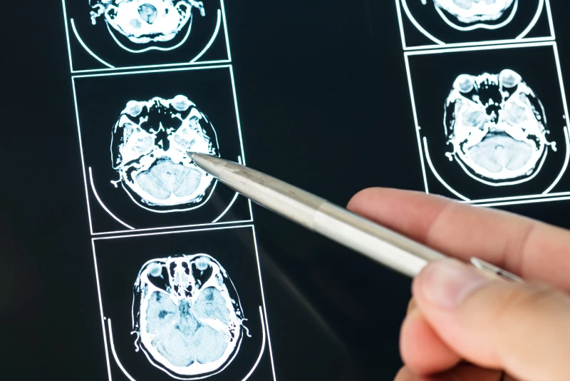 Brain injuries can be difficult to detect but have long-lasting effects. We work tirelessly to ensure victims receive the compensation they deserve.